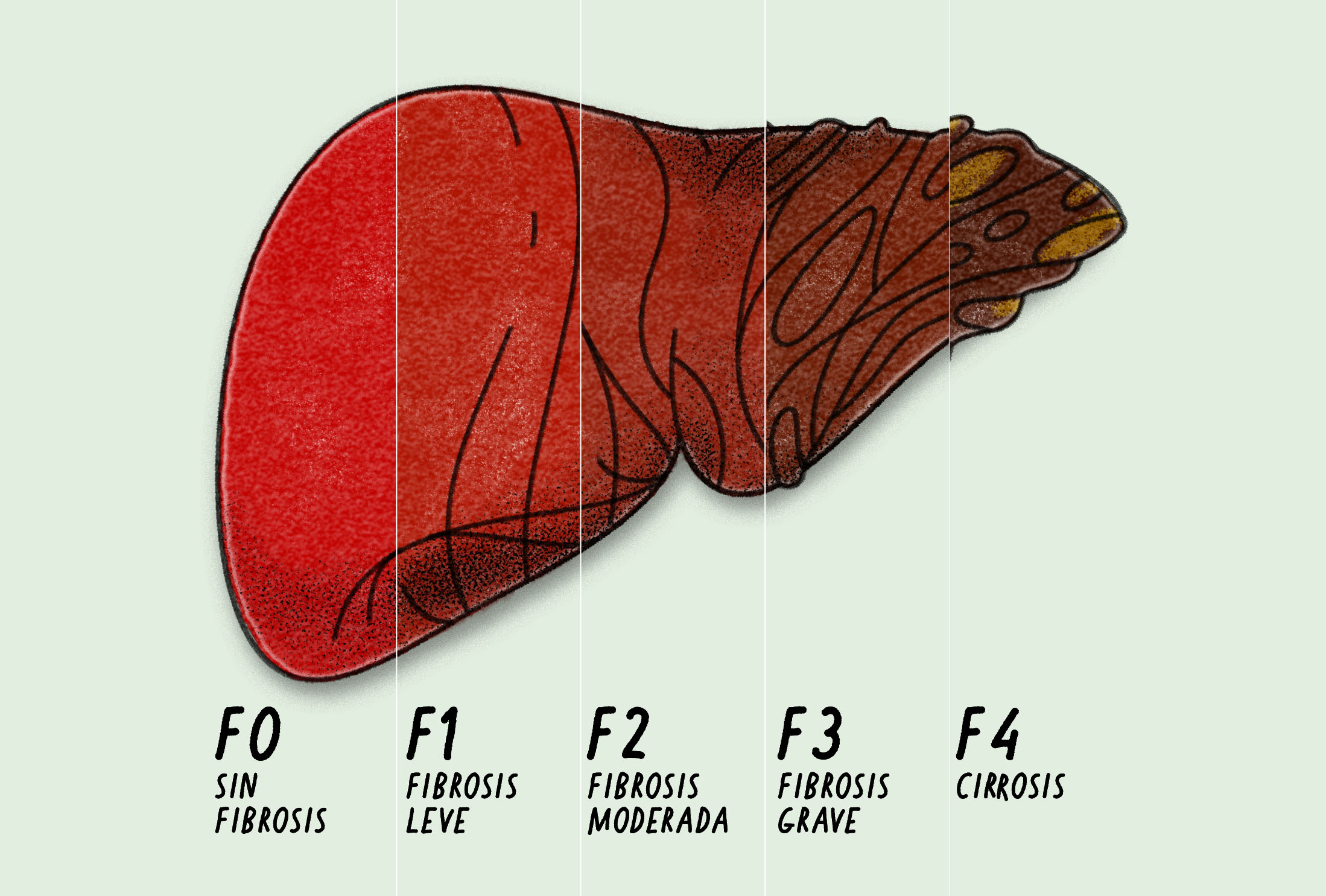 Cómo la hepatitis C afecta al hígado